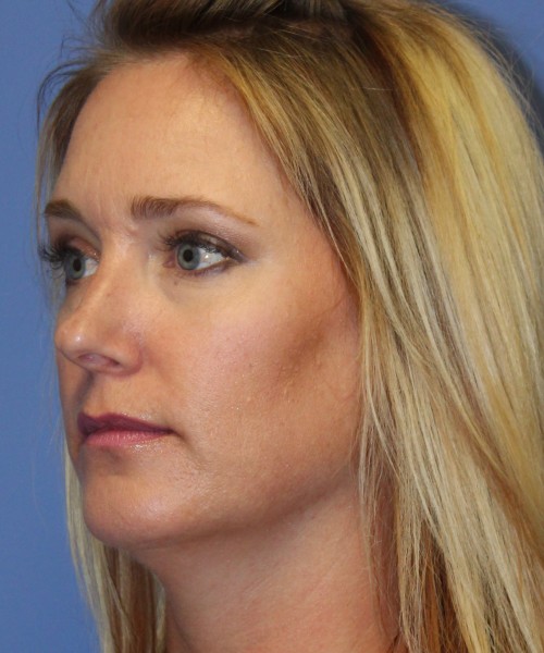 Rhinoplasty 4348 – Click HERE for more views before photo. Individual results may vary.