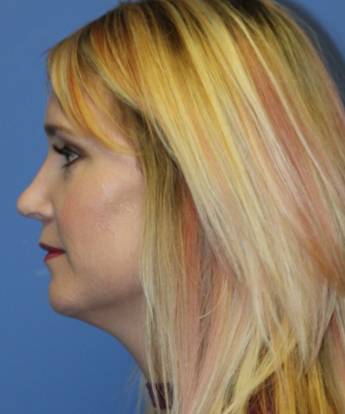Rhinoplasty 4348 – Click HERE for more views after photo. Individual results may vary.