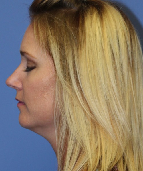Rhinoplasty 4348 – Click HERE for more views before photo. Individual results may vary.