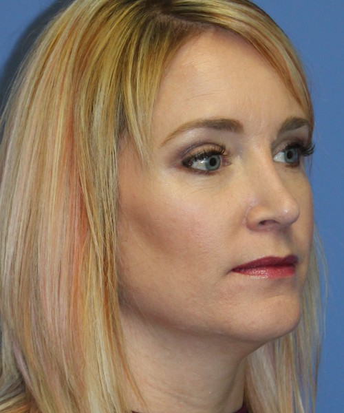 Rhinoplasty 4348 – Click HERE for more views after photo. Individual results may vary.