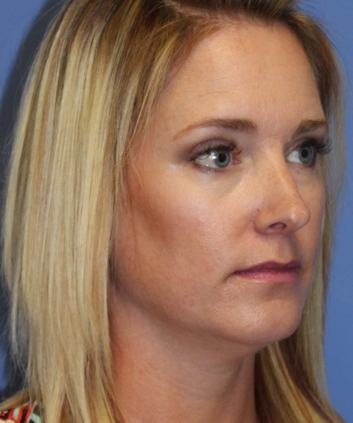 Rhinoplasty 4348 – Click HERE for more views before photo. Individual results may vary.