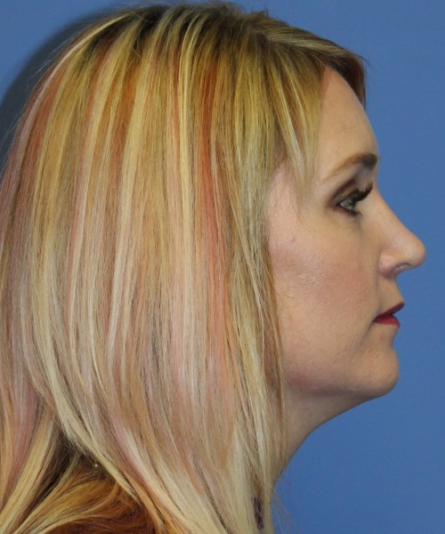 Rhinoplasty 4348 – Click HERE for more views after photo. Individual results may vary.