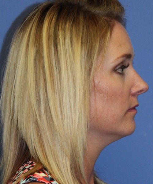 Rhinoplasty 4348 – Click HERE for more views before photo. Individual results may vary.