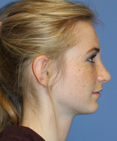 Rhinoplasty 4363 – Click HERE for more views after photo. Individual results may vary.