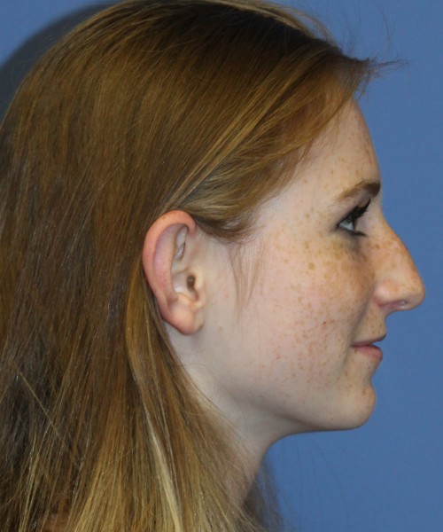 Rhinoplasty 4363 – Click HERE for more views before photo. Individual results may vary.