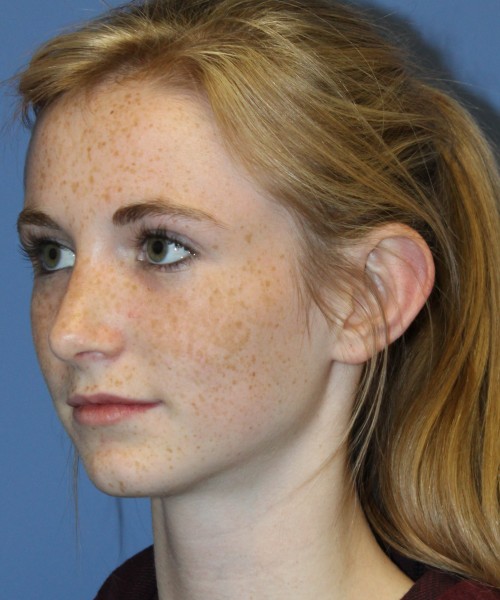 Rhinoplasty 4363 – Click HERE for more views after photo. Individual results may vary.