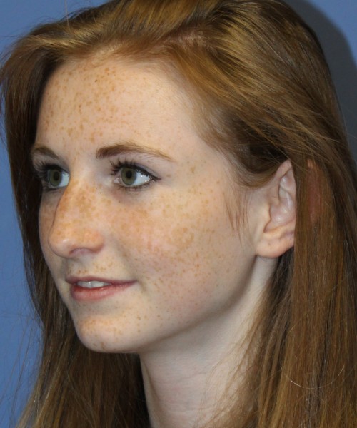 Rhinoplasty 4363 – Click HERE for more views before photo. Individual results may vary.