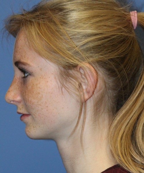 Rhinoplasty 4363 – Click HERE for more views after photo. Individual results may vary.