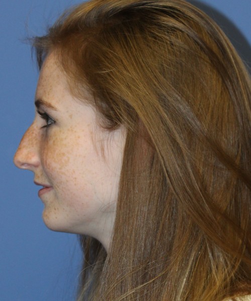 Rhinoplasty 4363 – Click HERE for more views before photo. Individual results may vary.