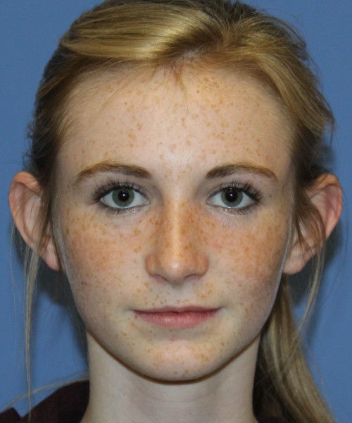 Rhinoplasty 4363 – Click HERE for more views after photo. Individual results may vary.