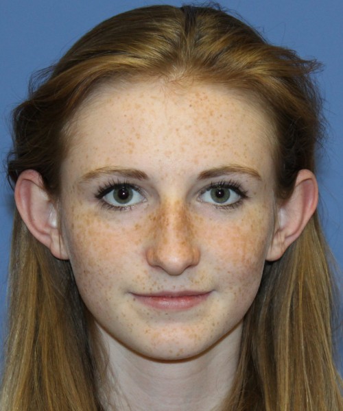 Rhinoplasty 4363 – Click HERE for more views before photo. Individual results may vary.