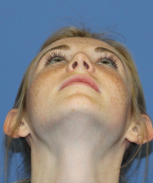 Rhinoplasty 4363 – Click HERE for more views after photo. Individual results may vary.