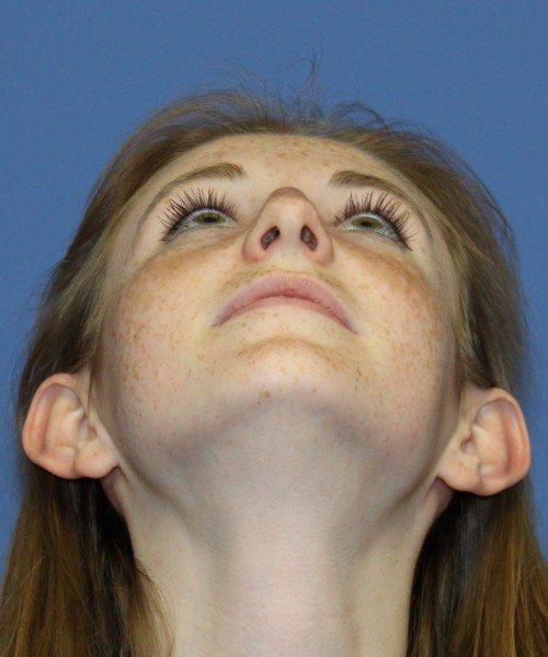 Rhinoplasty 4363 – Click HERE for more views before photo. Individual results may vary.