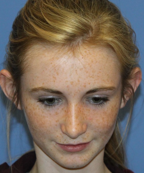 Rhinoplasty 4363 – Click HERE for more views after photo. Individual results may vary.