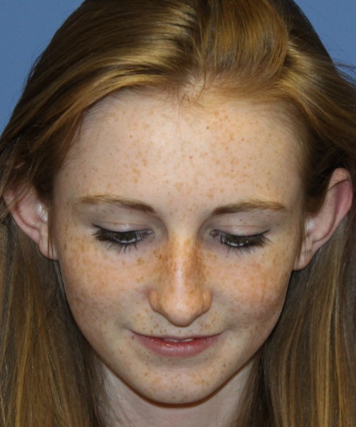 Rhinoplasty 4363 – Click HERE for more views before photo. Individual results may vary.