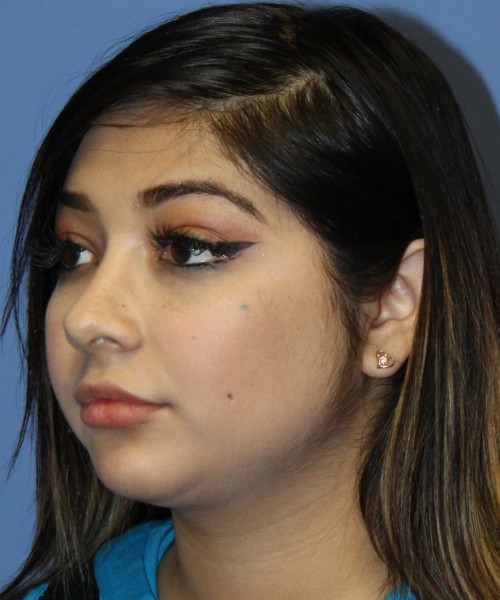 Dorsal Rhinoplasty, Buccal Fat Pad Removal 4378 – Click HERE for more views after photo. Individual results may vary.