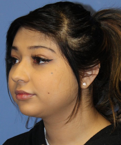 Dorsal Rhinoplasty, Buccal Fat Pad Removal 4378 – Click HERE for more views before photo. Individual results may vary.