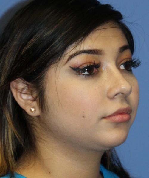 Dorsal Rhinoplasty, Buccal Fat Pad Removal 4378 – Click HERE for more views after photo. Individual results may vary.