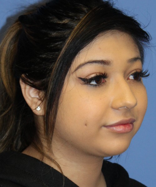 Dorsal Rhinoplasty, Buccal Fat Pad Removal 4378 – Click HERE for more views before photo. Individual results may vary.