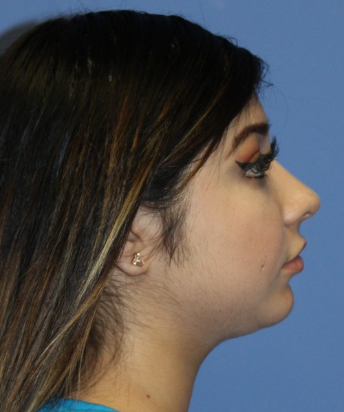 Dorsal Rhinoplasty, Buccal Fat Pad Removal 4378 – Click HERE for more views after photo. Individual results may vary.