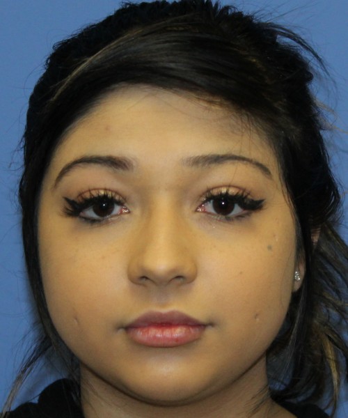 Dorsal Rhinoplasty, Buccal Fat Pad Removal 4378 – Click HERE for more views before photo. Individual results may vary.