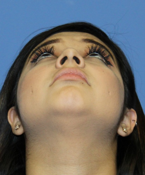 Dorsal Rhinoplasty, Buccal Fat Pad Removal 4378 – Click HERE for more views after photo. Individual results may vary.