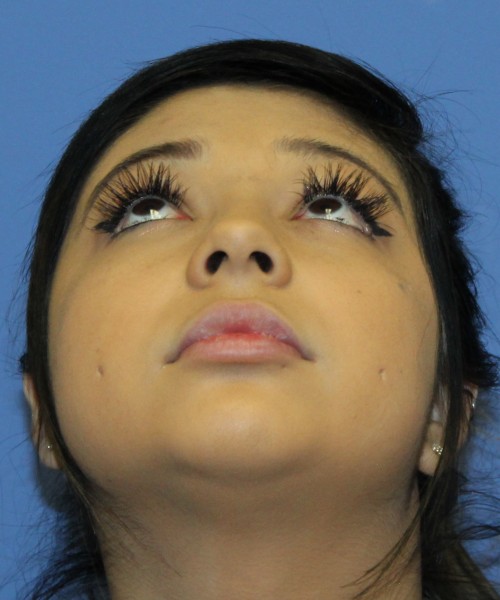 Dorsal Rhinoplasty, Buccal Fat Pad Removal 4378 – Click HERE for more views before photo. Individual results may vary.