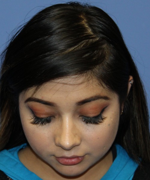 Dorsal Rhinoplasty, Buccal Fat Pad Removal 4378 – Click HERE for more views after photo. Individual results may vary.