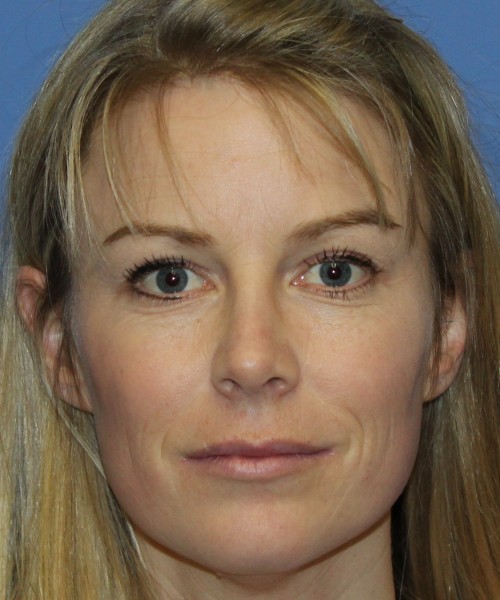 Rhinoplasty 4393 – Click HERE for more views after photo. Individual results may vary.