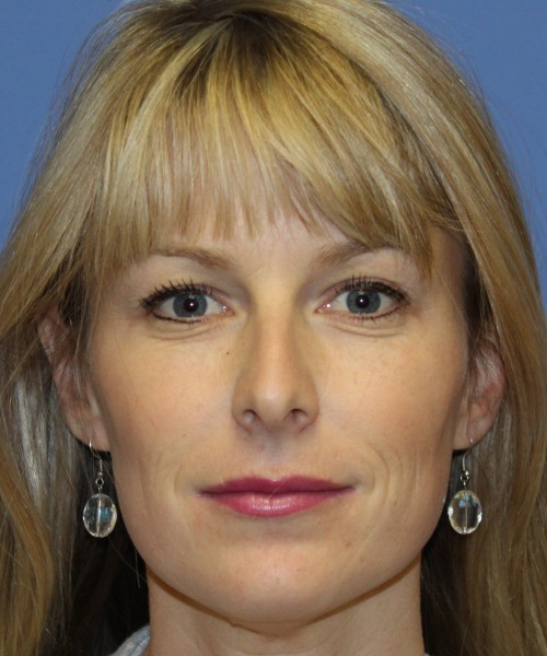Rhinoplasty 4393 – Click HERE for more views before photo. Individual results may vary.
