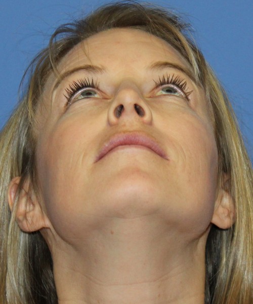 Rhinoplasty 4393 – Click HERE for more views after photo. Individual results may vary.