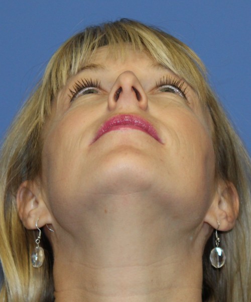 Rhinoplasty 4393 – Click HERE for more views before photo. Individual results may vary.