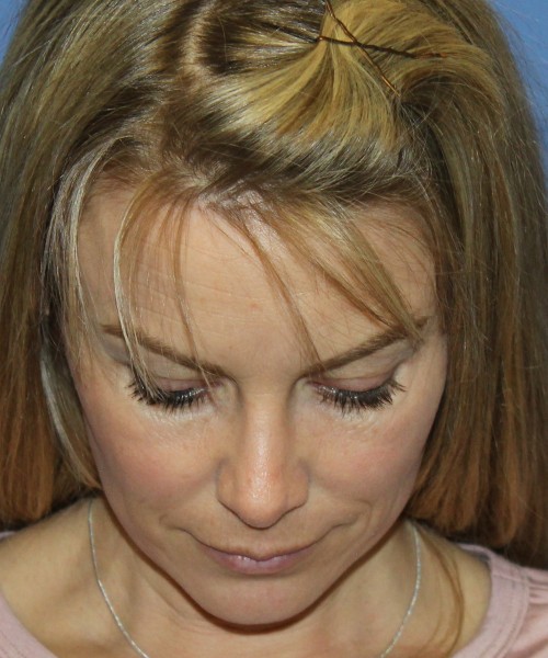 Rhinoplasty 4393 – Click HERE for more views after photo. Individual results may vary.
