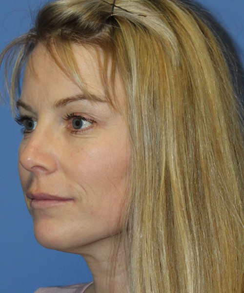 Rhinoplasty 4393 – Click HERE for more views after photo. Individual results may vary.