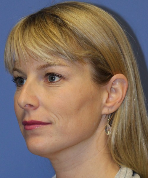 Rhinoplasty 4393 – Click HERE for more views before photo. Individual results may vary.