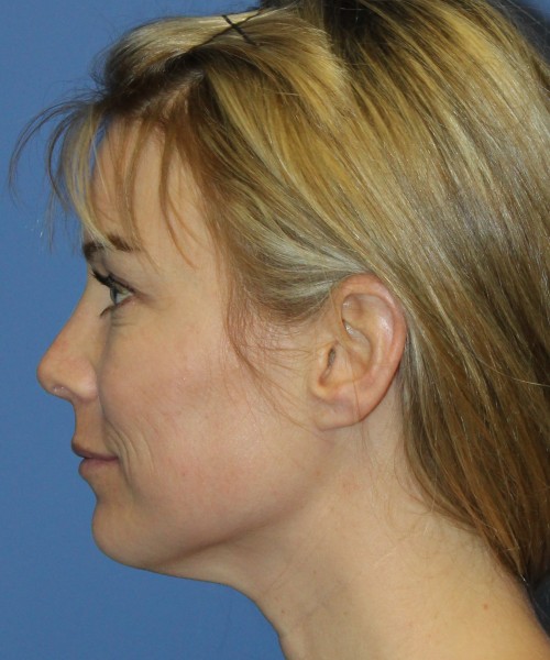 Rhinoplasty 4393 – Click HERE for more views after photo. Individual results may vary.