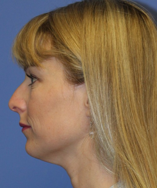 Rhinoplasty 4393 – Click HERE for more views before photo. Individual results may vary.