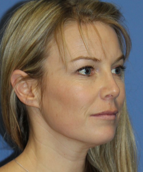 Rhinoplasty 4393 – Click HERE for more views after photo. Individual results may vary.
