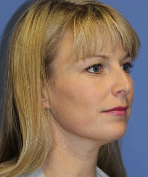 Rhinoplasty 4393 – Click HERE for more views before photo. Individual results may vary.