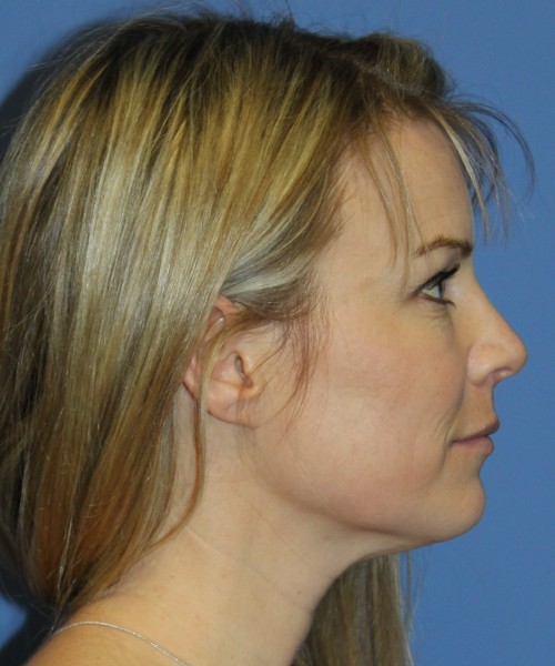 Rhinoplasty 4393 – Click HERE for more views after photo. Individual results may vary.