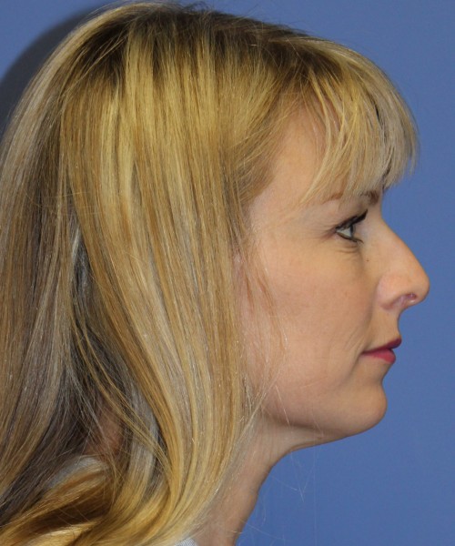 Rhinoplasty 4393 – Click HERE for more views before photo. Individual results may vary.