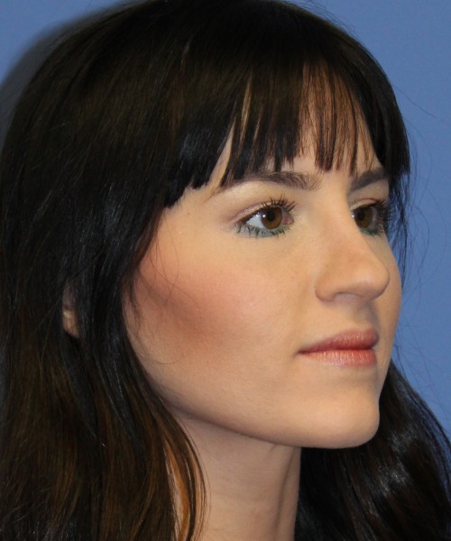 Rhinoplasty 4408 – Click HERE for more views after photo. Individual results may vary.