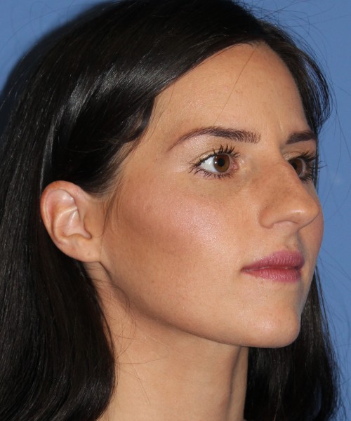 Rhinoplasty 4408 – Click HERE for more views before photo. Individual results may vary.