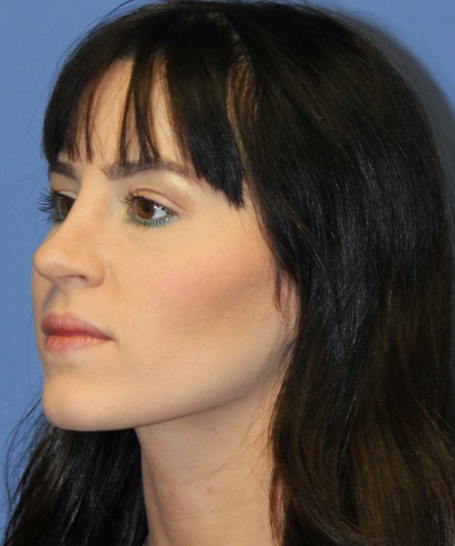 Rhinoplasty 4408 – Click HERE for more views after photo. Individual results may vary.