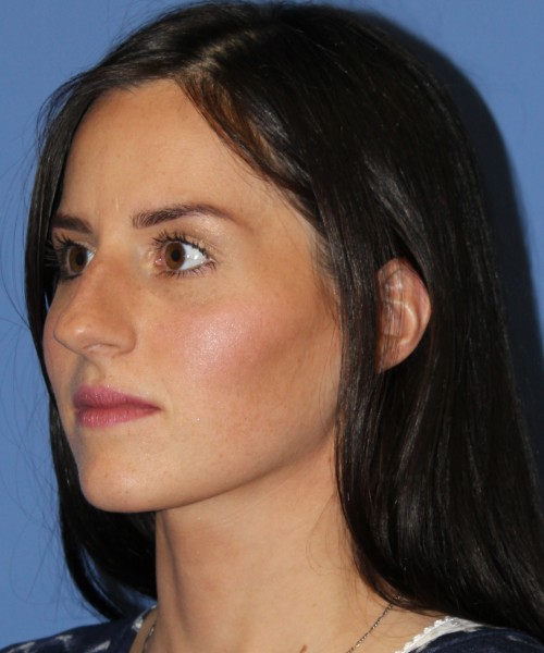 Rhinoplasty 4408 – Click HERE for more views before photo. Individual results may vary.