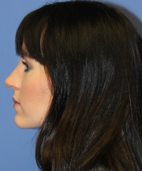 Rhinoplasty 4408 – Click HERE for more views after photo. Individual results may vary.