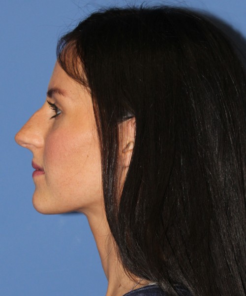 Rhinoplasty 4408 – Click HERE for more views before photo. Individual results may vary.