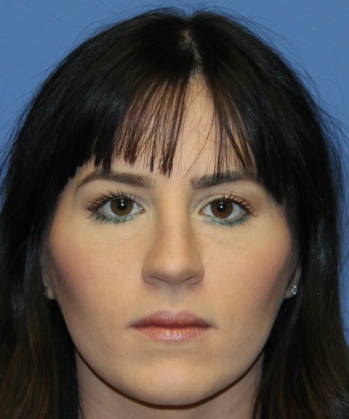 Rhinoplasty 4408 – Click HERE for more views after photo. Individual results may vary.