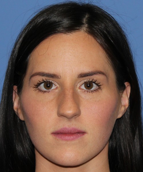 Rhinoplasty 4408 – Click HERE for more views before photo. Individual results may vary.
