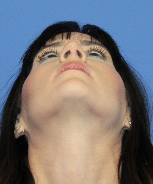 Rhinoplasty 4408 – Click HERE for more views after photo. Individual results may vary.